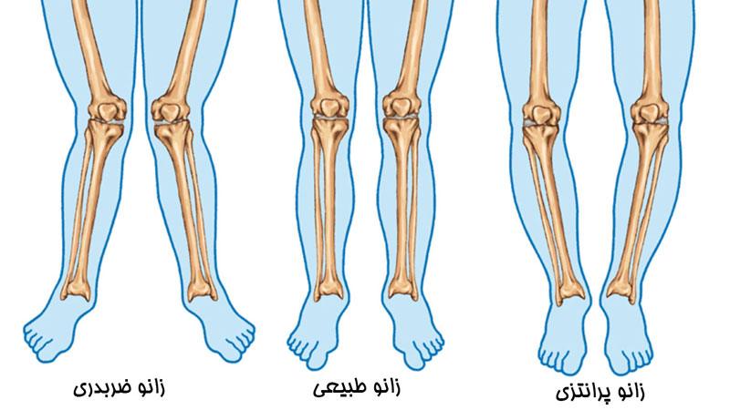 تفاوت پای پرانتزی و زانوی پرانتزی